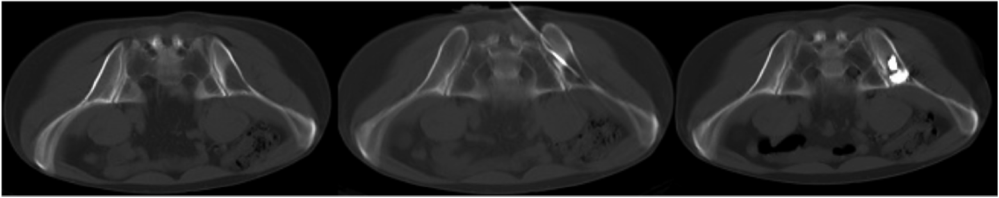 Surgical treatment for pelvic bone metastases - Buharov - Journal of Modern  Oncology